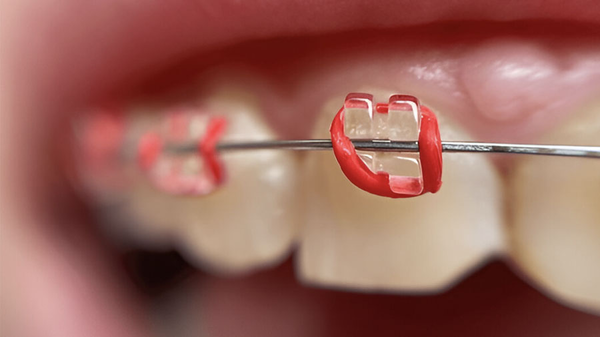 Những Điều Cần Biết Về Mắc Cài Polycarbonate Trong Chỉnh Nha