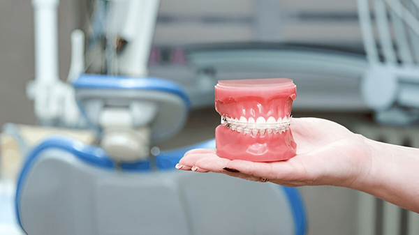 Cách Mắc Cài Sứ Đơn Tinh Thể Sapphire Nâng Tầm Điều Trị Chỉnh Nha Thẩm Mỹ