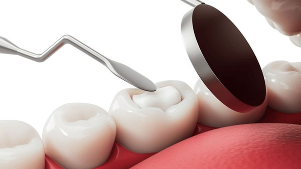 Preventive Dental Materials: Protecting Oral Health With Advanced Technologies