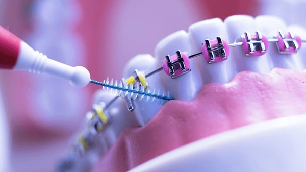 Mắc Cài Titanium: Hướng Dẫn Toàn Diện Về Giải Pháp Tương Thích Sinh Học