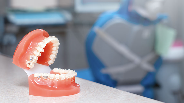 What Are Ceramic Brackets? Types, Features, And Clinical Advantages