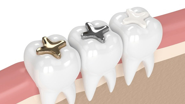 Dental Sealant Application Guide: Etching, Isolation, Curing & Quality Assurance