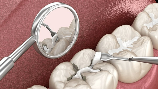 High‑Viscosity GICs: Composition, Properties, Clinical Uses & ART Evidence