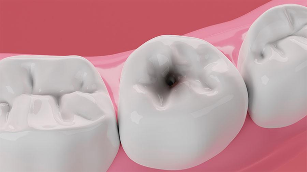 Enamel Decay: Causes, Treatment And Prevention Enamel Decay: Causes, Treatment And Prevention