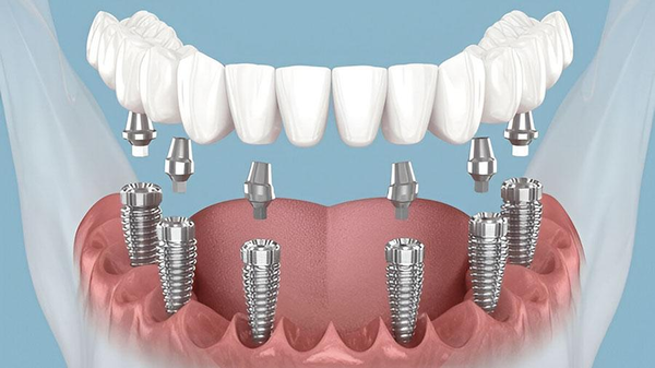 Implants For People Who Lost All Teeth Implants For People Who Lost All Teeth