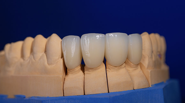 Ceramic Frameworks In Dentistry: A Comprehensive Overview Ceramic Frameworks In Dentistry: A Comprehensive Overview