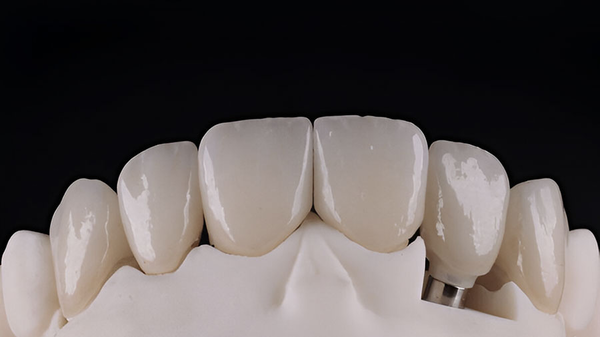 Lithium Disilicate (E.max) Trong Khung Sườn Sứ Nha Khoa: Phân Tích Toàn Diện Lithium Disilicate (E.max) Trong Khung Sườn Sứ Nha Khoa: Phân Tích Toàn Diện