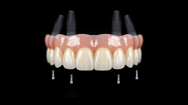 Polyetherketoneketone (PEKK): Revolutionizing Dental Prosthetics Polyetherketoneketone (PEKK): Revolutionizing Dental Prosthetics