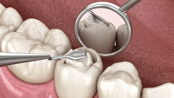 Tối Ưu Hiệu Quả Sealant Có Độn: Cách Ly, Enameloplasty Và Chiến Lược Keo Dán