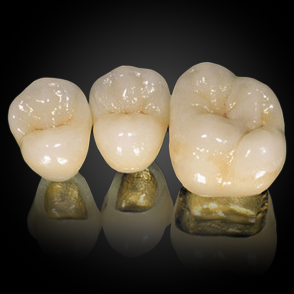 Phục Hình Sứ Kim Loại Quý PFM