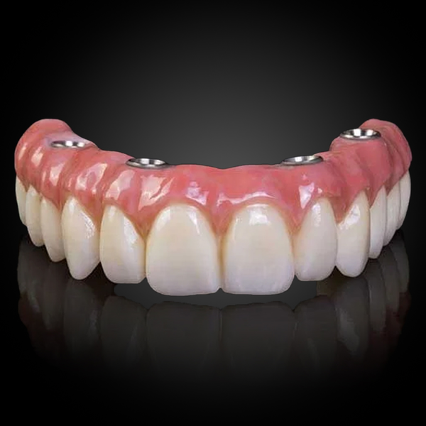 Implant-Retained Hybrid Dentures