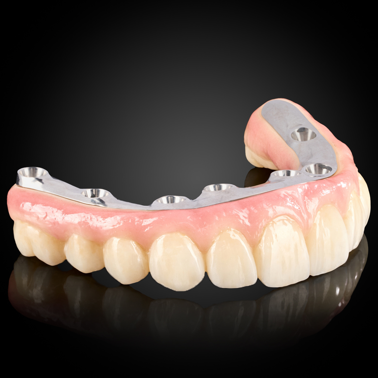 Full Arch Implant Prosthesis