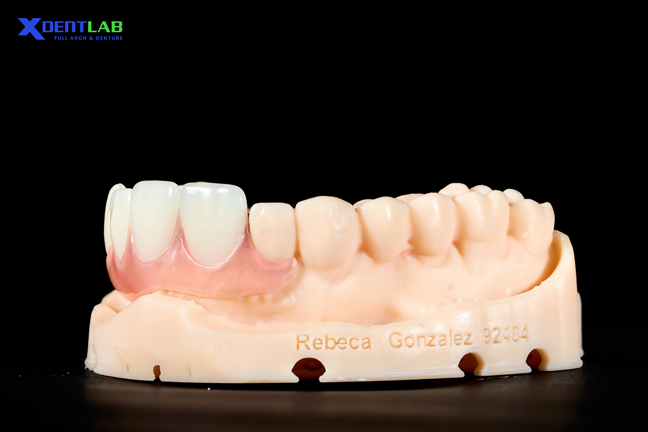 Partial Denture