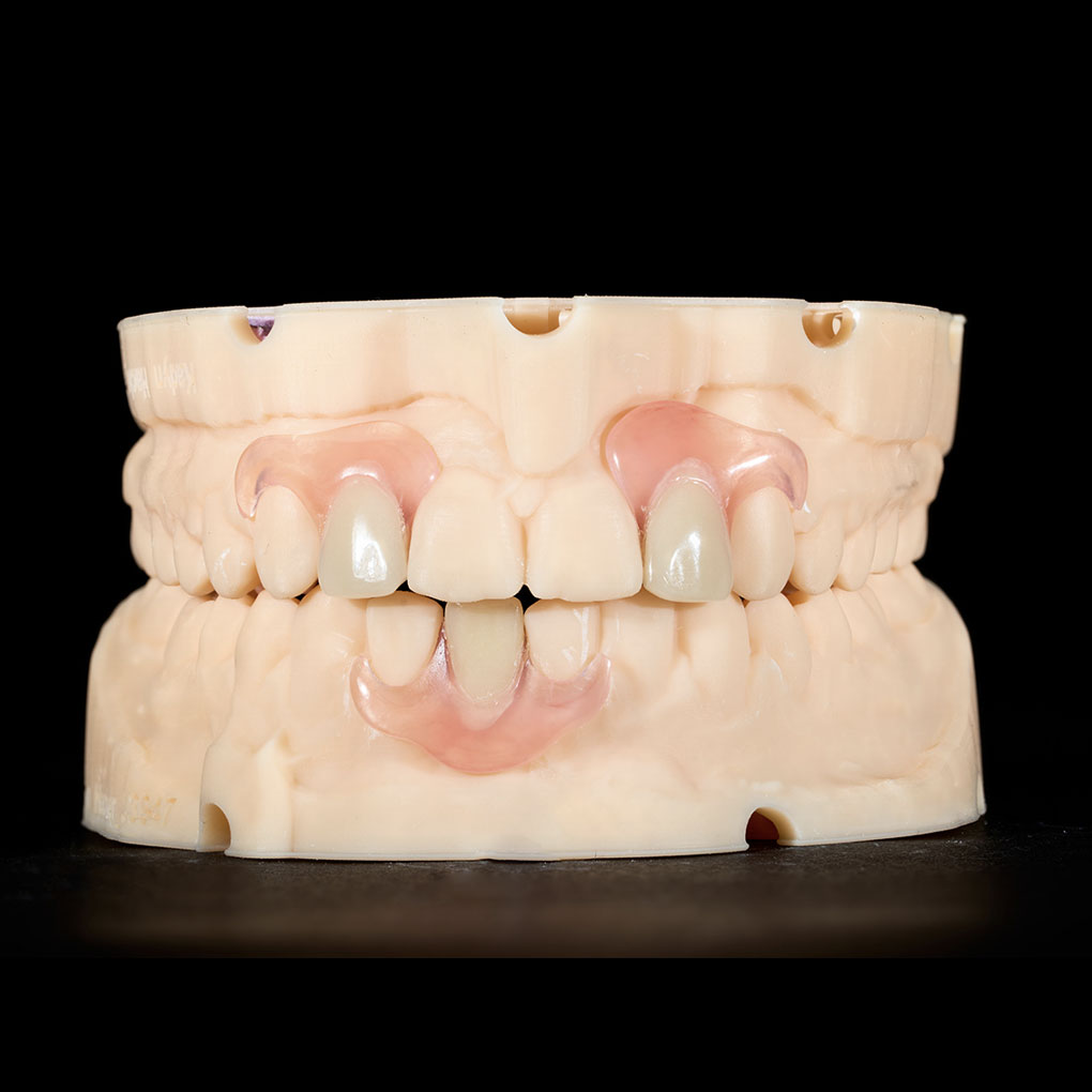 Phục Hình Tháo Lắp Bán Hàm