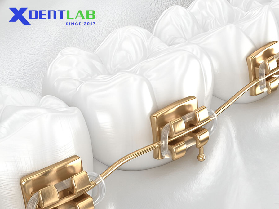 Những Tiến Bộ Gần Đây Về Dây Cung Chỉnh Nha Những Tiến Bộ Gần Đây Về Dây Cung Chỉnh Nha