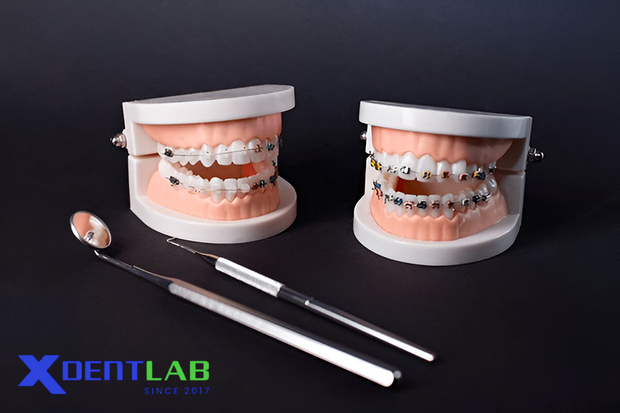 Phân Tích So Sánh Vật Liệu Mắc Cài Phân Tích So Sánh Vật Liệu Mắc Cài