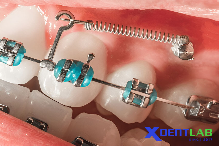 Những Phát Triển Mới Về Vật Liệu Mắc Cài Những Phát Triển Mới Về Vật Liệu Mắc Cài
