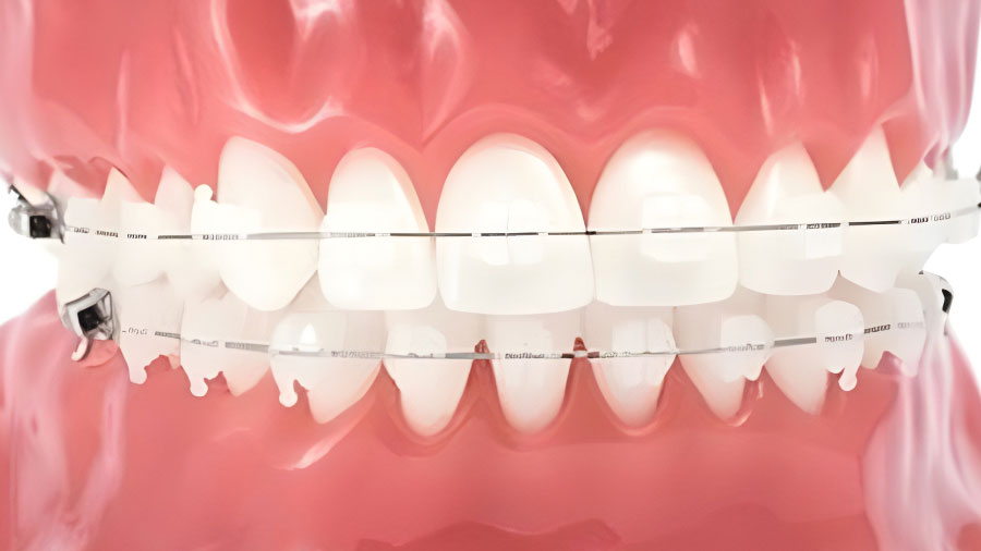 Vật Liệu Composite Gia Cường Sợi Trong Mắc Cài Chỉnh Nha: Đổi Mới Và Ưu Điểm