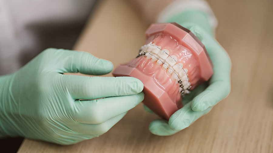 Cách Mắc Cài Sứ Đa Tinh Thể Cải Thiện Điều Trị Chỉnh Nha Thẩm Mỹ