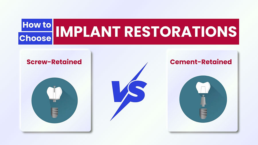Implant Restorations: Screw-Retained vs Cement-Retained