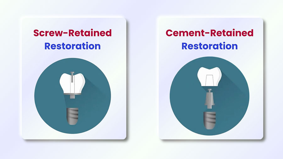 So, What Is The Difference Between Screw-Retained vs. Cement-Retained?