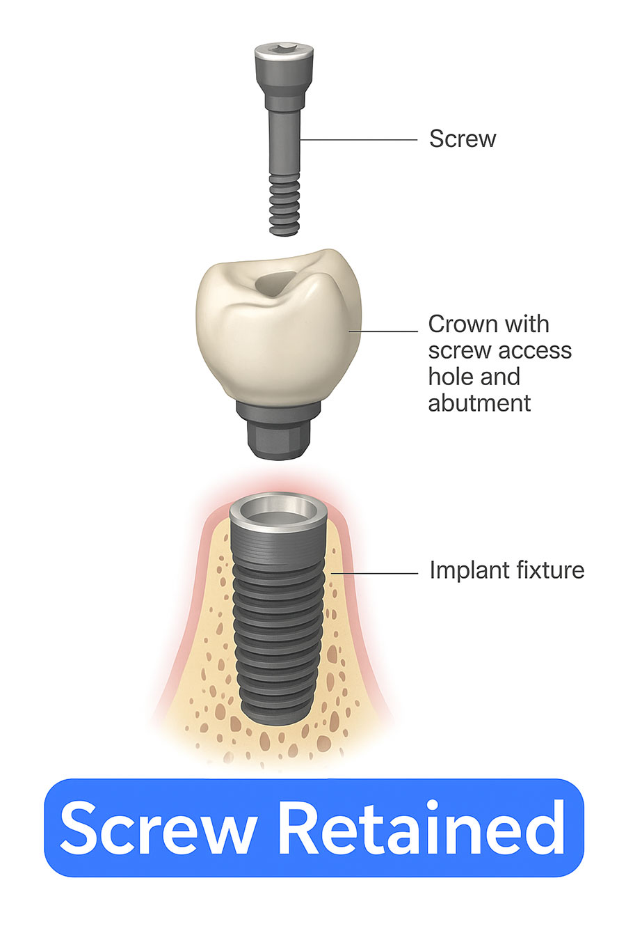 What Are Screw-Retained Restorations?