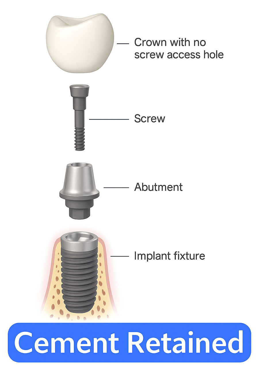 What Are Cement-Retained Restorations?
