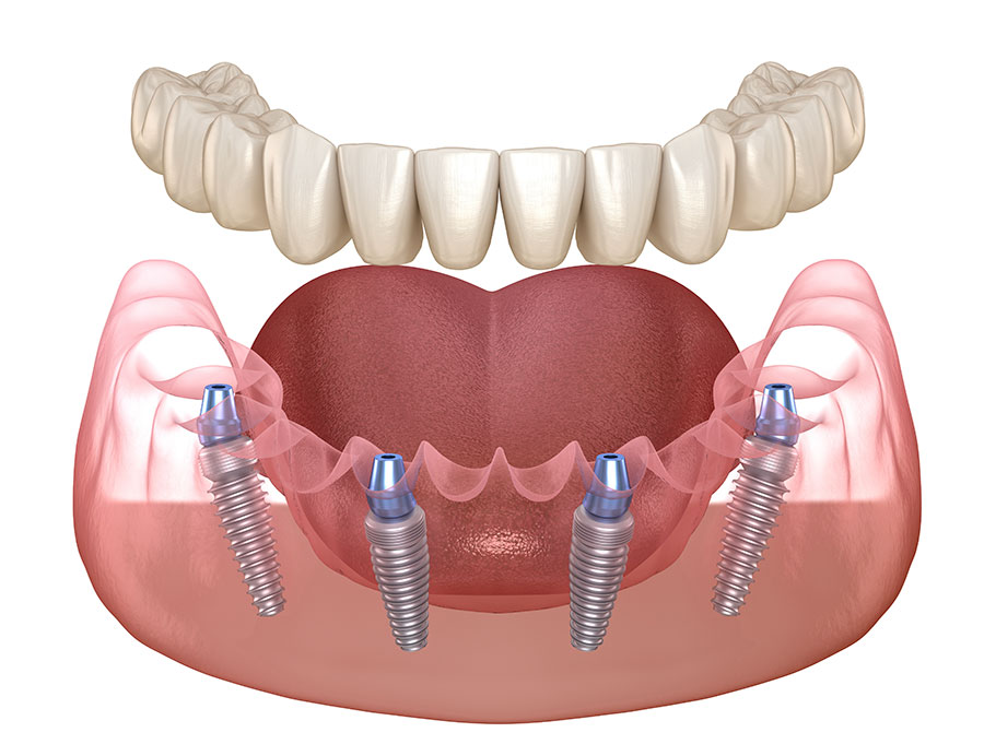 Implant-Supported vs Implant-Retained Dentures: What’s the Difference?
