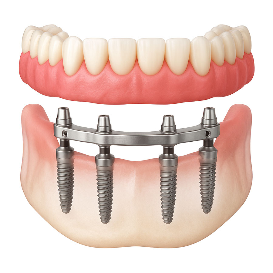 What Are Implant‑Supported Dentures?