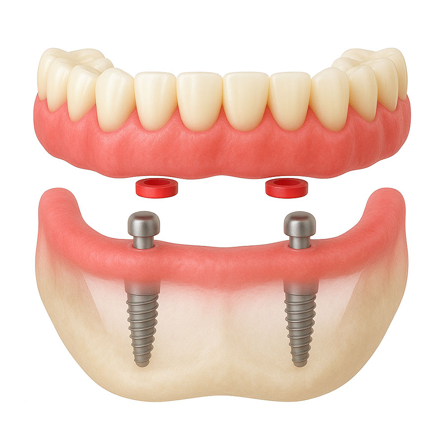 What Are Implant‑Retained Dentures?