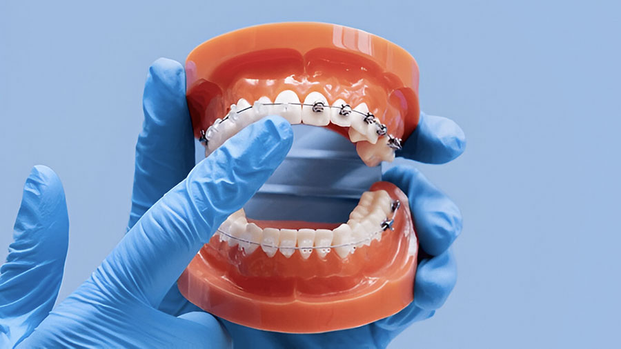 Mắc Cài Polymer Trong Chỉnh Nha: Giải Pháp Thẩm Mỹ Và Những Tiến Bộ Mới