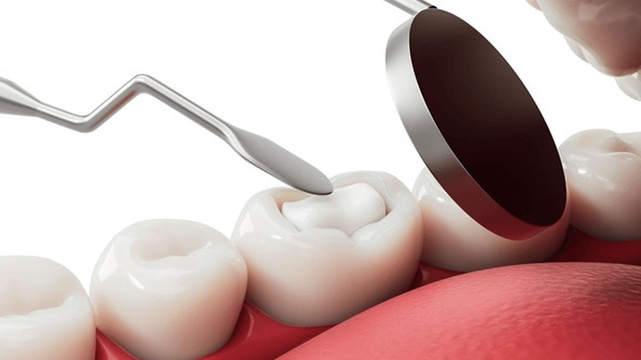 Preventive Dental Materials: Protecting Oral Health With Advanced Technologies