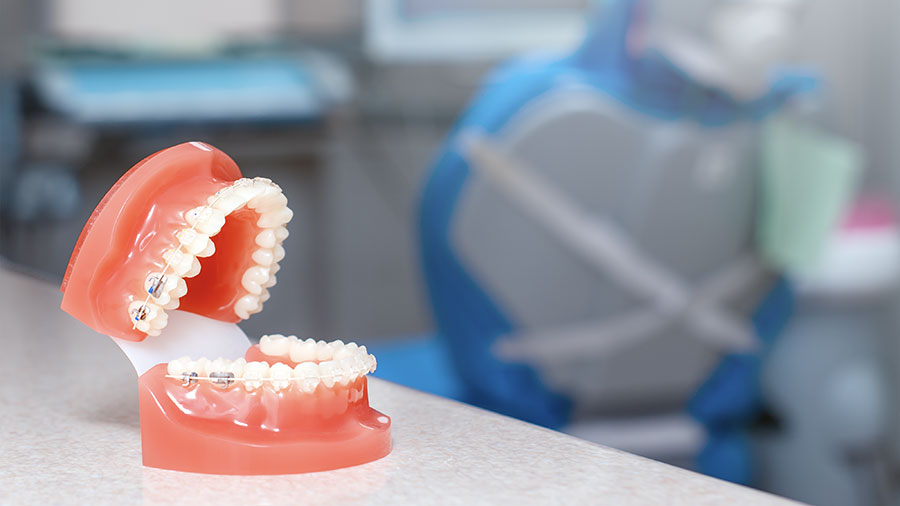 What Are Ceramic Brackets? Types, Features, And Clinical Advantages What Are Ceramic Brackets? Types, Features, And Clinical Advantages