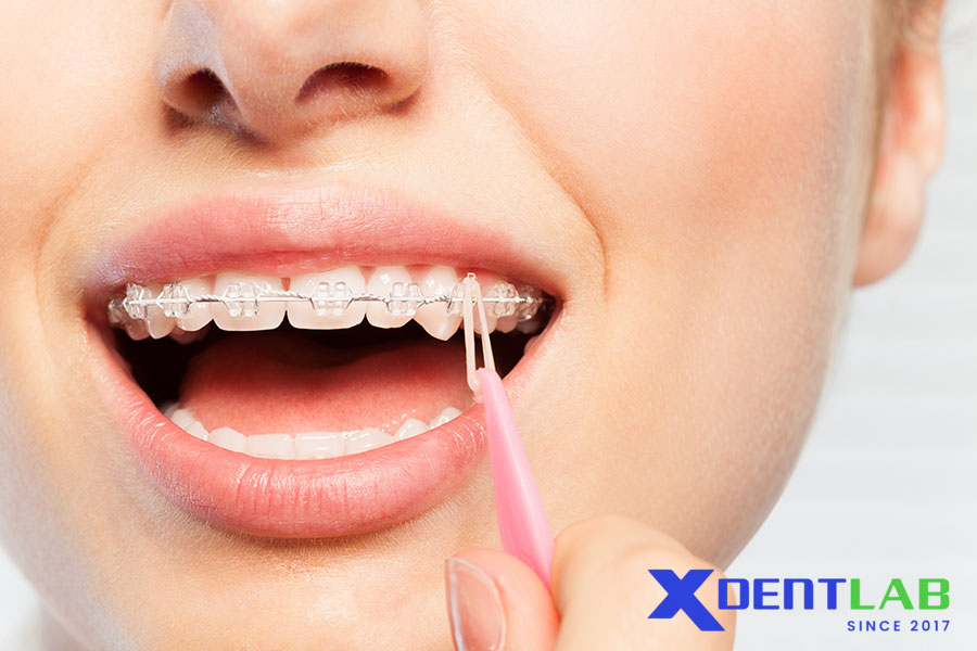 Applications of Ceramic Brackets in Orthodontics Applications of Ceramic Brackets in Orthodontics