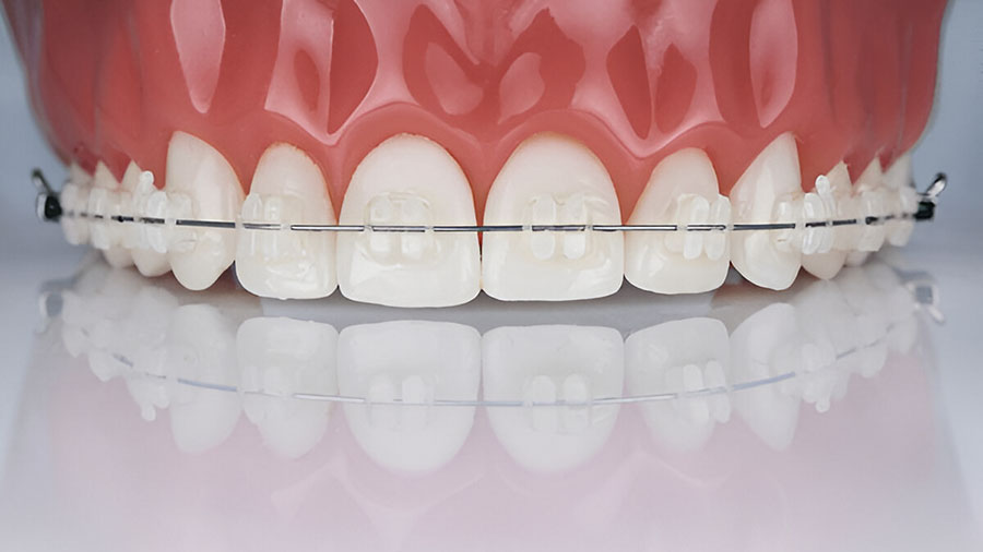 Vì Sao Mắc Cài Polyurethane Đang Làm Nên Cuộc Cách Mạng Trong Chỉnh Nha Hiện Đại