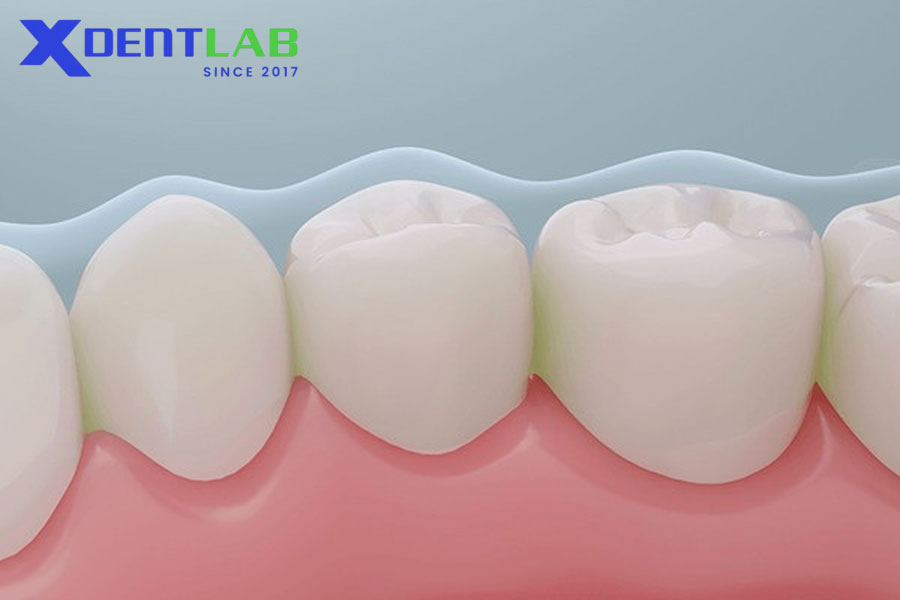 Advantages of Fluoride Varnish Advantages of Fluoride Varnish