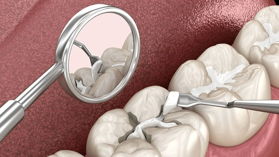 High‑Viscosity GICs: Composition, Properties, Clinical Uses & ART Evidence