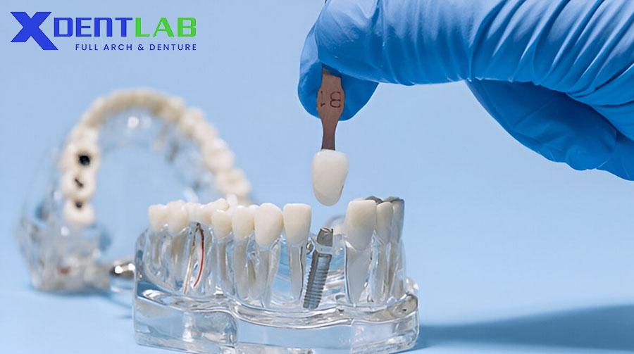 Four signs of dental implant failure? Four signs of dental implant failure?
