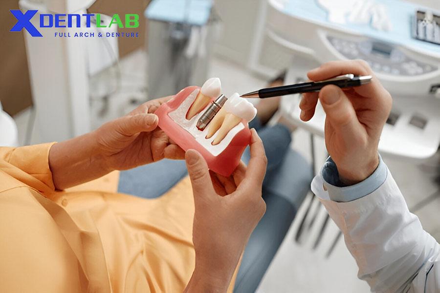 What is the cause of dental implant failure? What is the cause of dental implant failure?