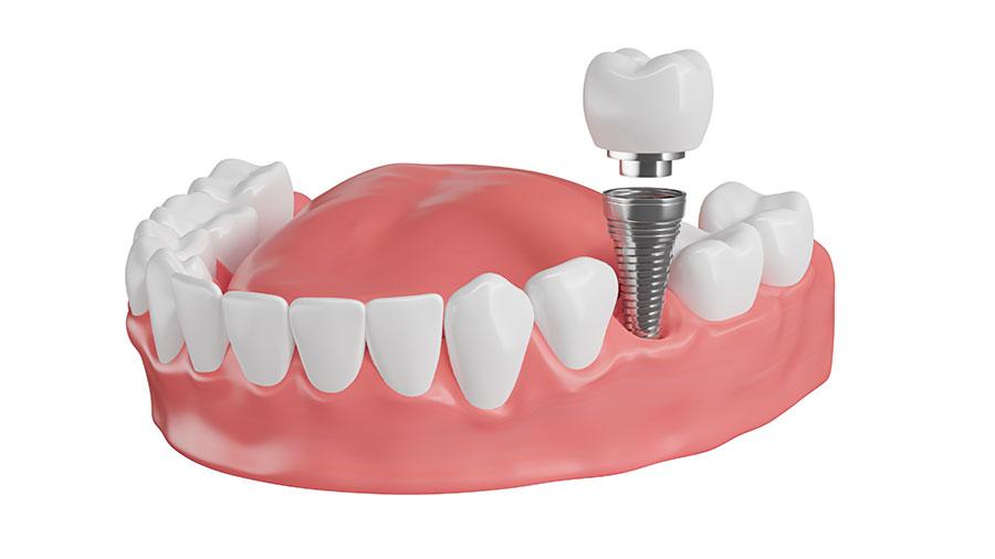Cấy ghép Implant Cấy ghép Implant