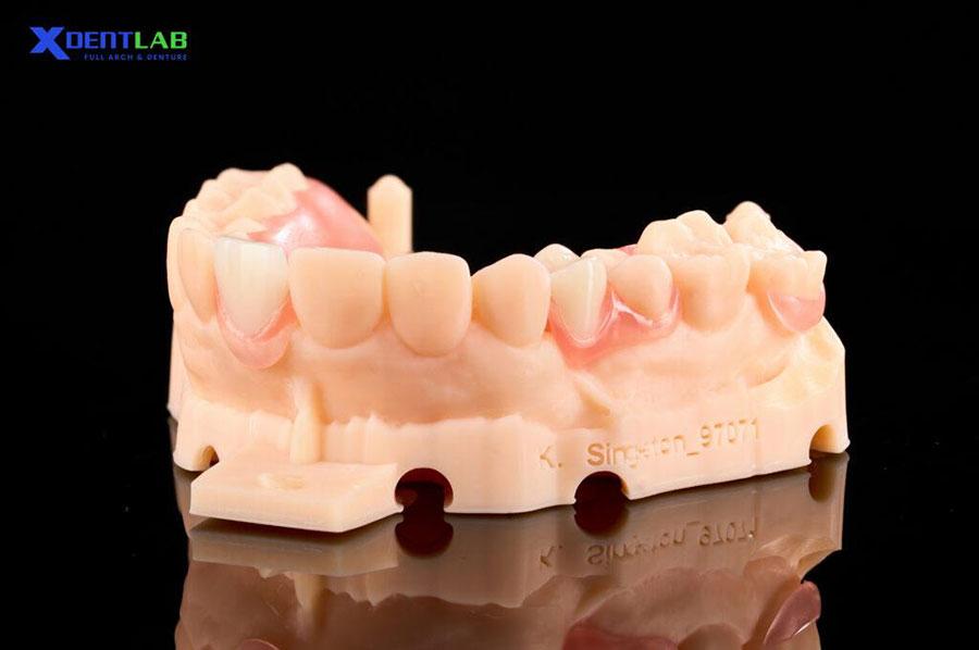 Hàm giả tháo lắp từng phần (Partial Removable Dentures) Hàm giả tháo lắp từng phần (Partial Removable Dentures)