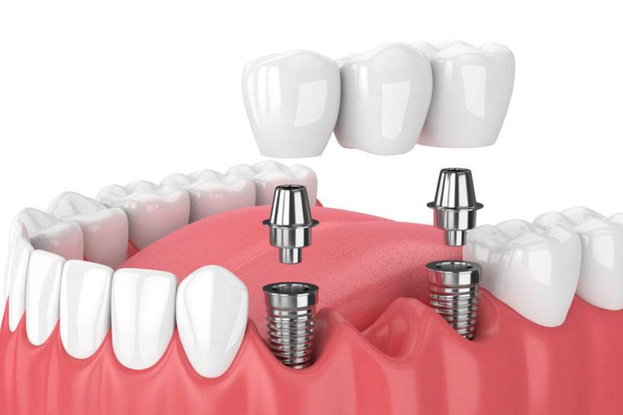 Cầu răng trên implant (Bridge on Implants) Cầu răng trên implant (Bridge on Implants)