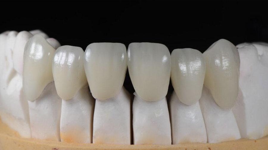 How To Handle Ill-Fitting Zirconia Crowns