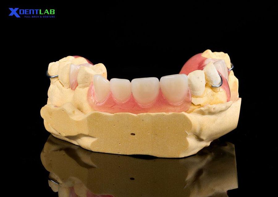 Removable Partial Denture (Acrylic Partial) and Flexible Partial Denture (Valplast Partial) Removable Partial Denture (Acrylic Partial) and Flexible Partial Denture (Valplast Partial)