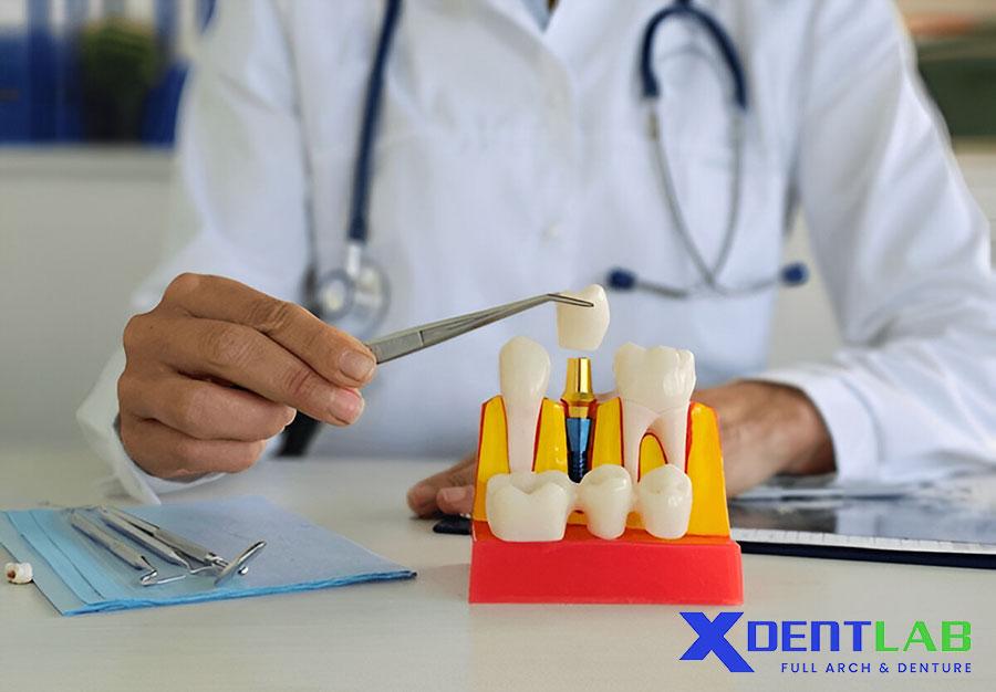 Implant Implant