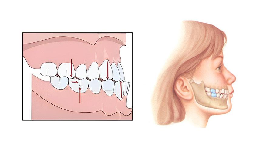 Khớp cắn chuẩn Khớp cắn chuẩn