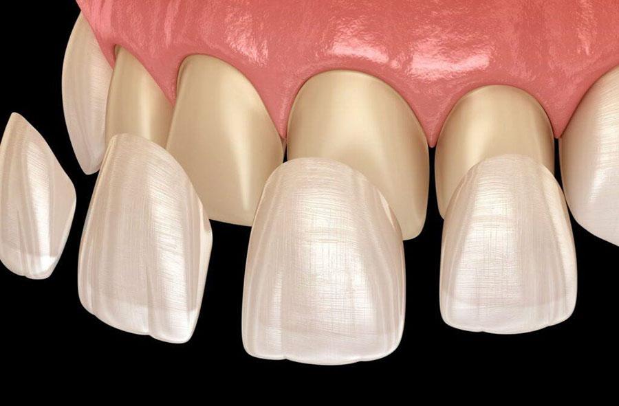Porcelain teeth fit the natural teeth Porcelain teeth fit the natural teeth