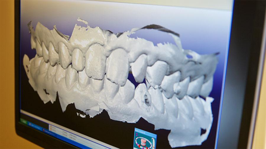 What Is a Digital Dental Impression? What Is a Digital Dental Impression?
