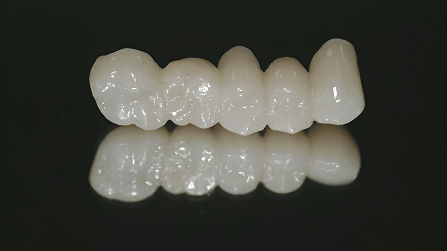 Crown And Bridge: Monolithic Zirconia Vs. Esthetic Multilayer Zirconia Crown And Bridge: Monolithic Zirconia Vs. Esthetic Multilayer Zirconia