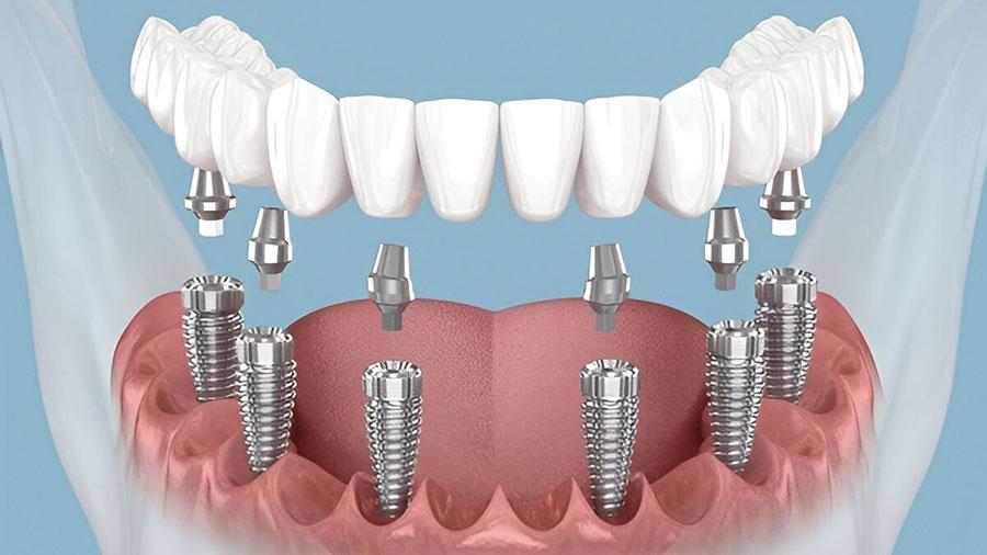 Implants For People Who Lost All Teeth